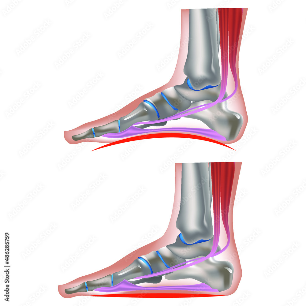 flat feet. Deformation of the longitudinal and parallel arches of the ...
