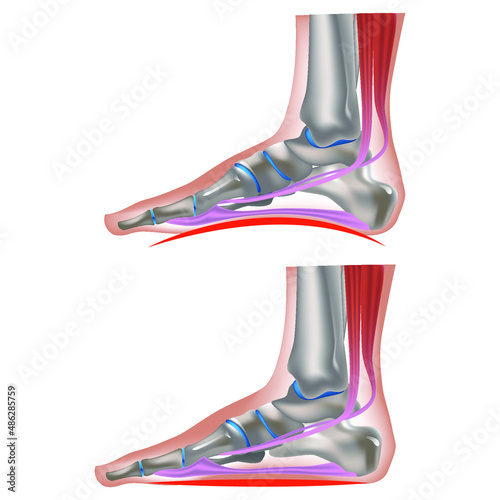 flat feet. Deformation of the longitudinal and parallel arches of the feet. Overweight. Strong stress on the joints. Human leg anatomy. 3D rendering. Vector illustration