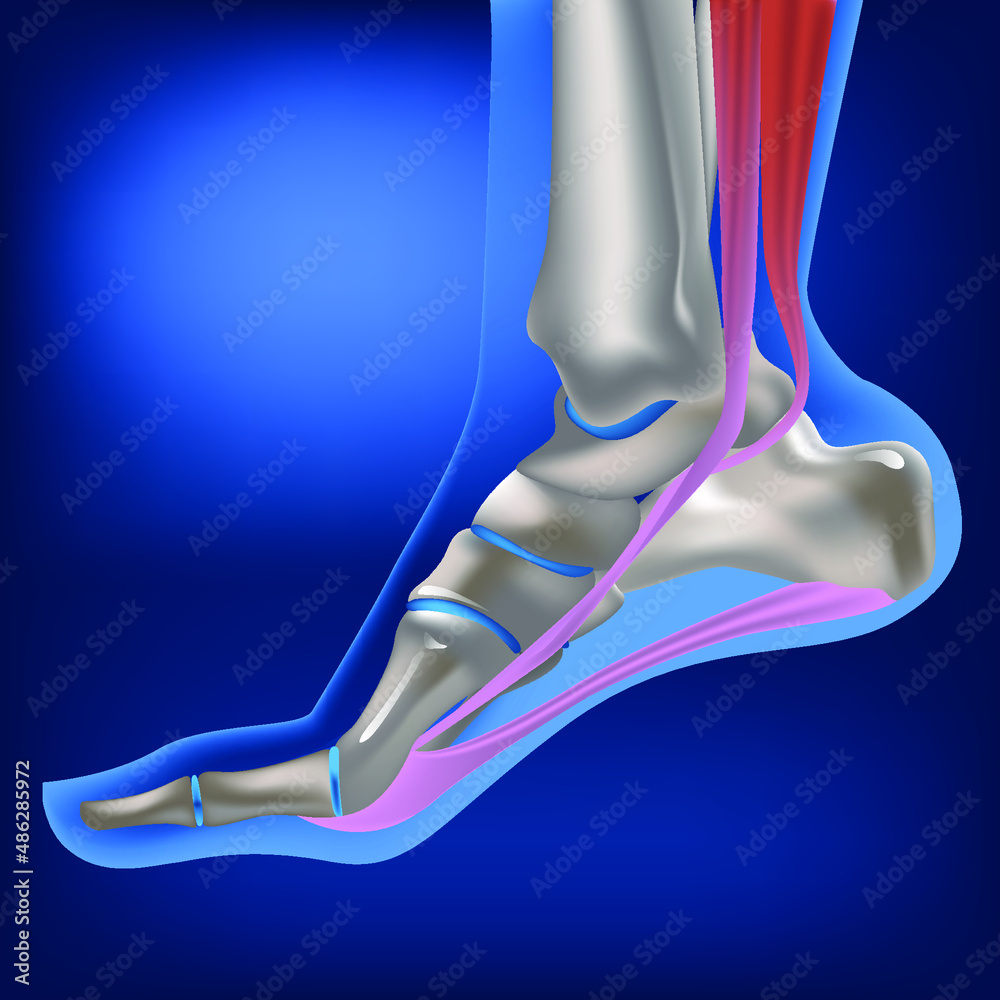 Plantar fasciitis, plantar fasciosis. inflammatory and degenerative changes in plantar fascia
