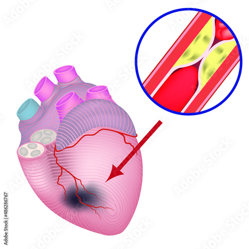 ischemia of the heart. Vascular atherosclerosis. damage to the coronary arteries. Fatty plaques on the walls. Blood clots. High risk of death. Vector illustration.