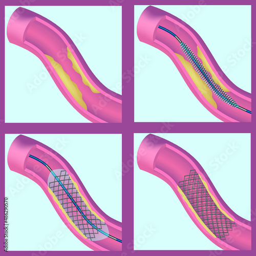 Stening of blood vessels and veins. Restoration of blood flow. The formation of fatty plaques. Coronary heart disease. Atherosclerosis of the arteries. Insufficiency of blood circulation. Vector 