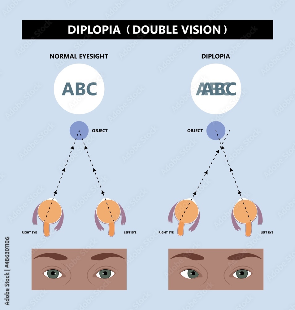 Diplopia double vision test exam brain nerve dry eye palsy gravis