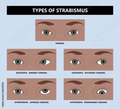 Diplopia double vision test exam brain nerve dry eye palsy gravis muscle loss head brain tumor squint ptosis gaze myopia miosis tropia Phoria maddox rod horner's ocular amblyopia Lazy stroke abducens