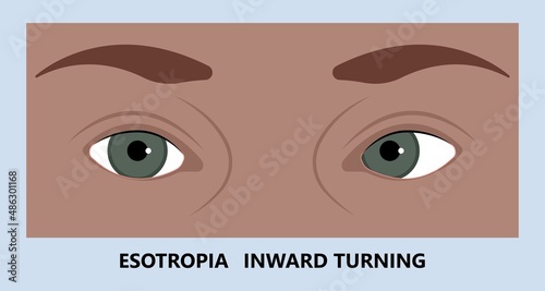 Diplopia double vision test exam brain nerve dry eye palsy gravis muscle loss head brain tumor squint ptosis gaze myopia miosis tropia Phoria maddox rod horner's ocular amblyopia Lazy stroke abducens
