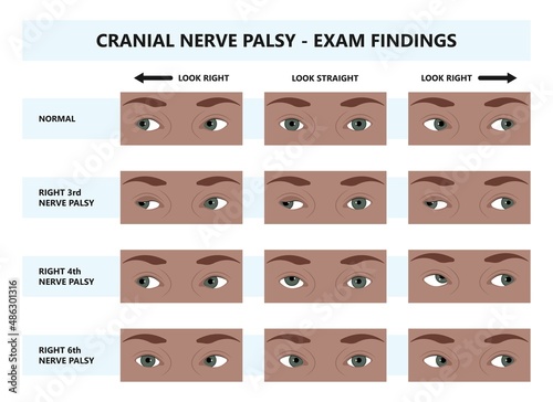 Diplopia double vision test exam brain nerve dry eye palsy gravis muscle loss head brain tumor squint ptosis gaze myopia miosis tropia Phoria maddox rod horner's ocular amblyopia Lazy stroke abducens
