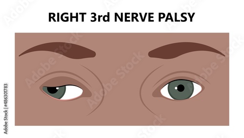Diplopia double vision test exam brain nerve dry eye palsy gravis muscle loss head brain tumor squint ptosis gaze myopia miosis tropia Phoria maddox rod horner's ocular amblyopia Lazy stroke abducens