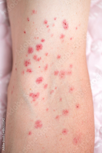 Spots on human skin. Rash from infection. Allergies and dermatitis. Scratches and injuries from grinding sparks. firecracker sparks photo