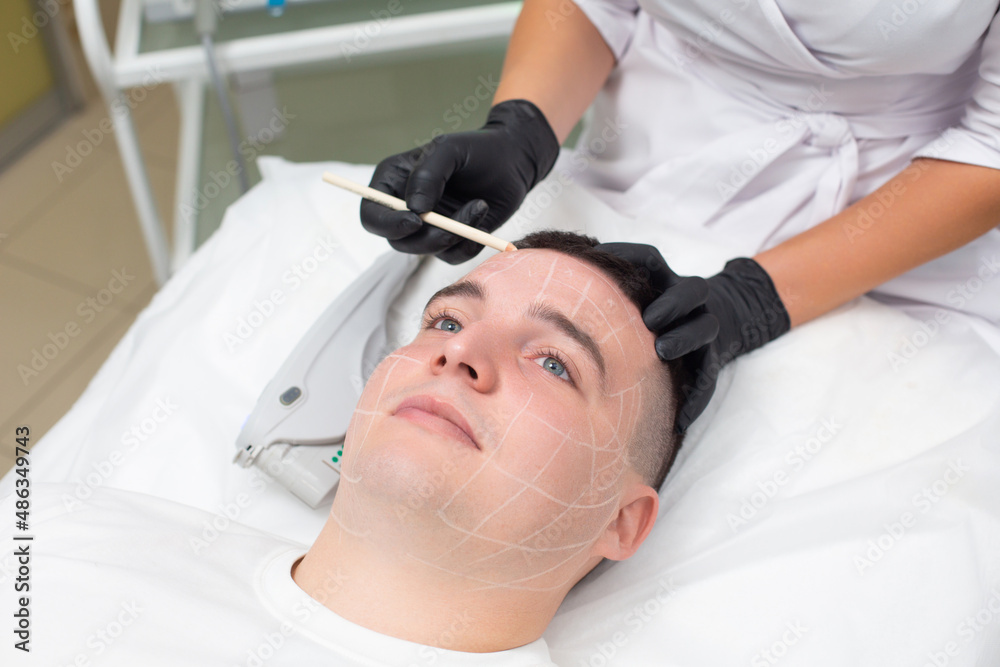 Portrait of a young handsome man lying on a couch in a dermatological office, while the hands of a cosmetologist in black medical gloves hold a white cosmetic pencil and make marks on the guy face for Portrait of a young handsome man lying on a couch in a dermatological office, while the hands of a cosmetologist in black medical gloves hold a white cosmetic pencil and make marks on the guy face for