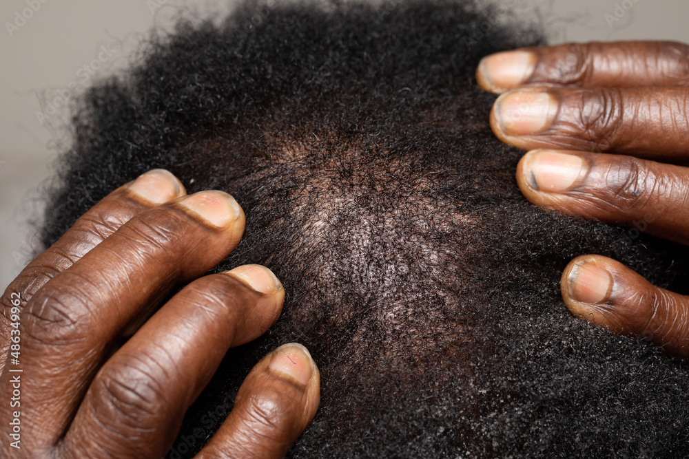 Eczema On Scalp African American