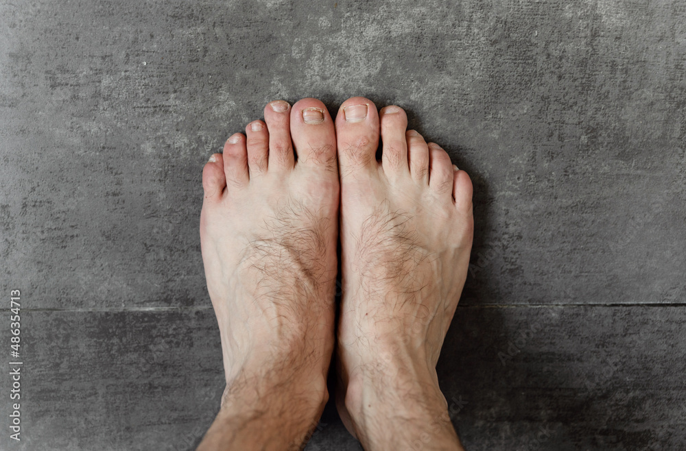 Fototapeta premium male feet with fungus and different dermatological problems close-up on a dark background. hairy feet. toenail problem. foot skin problem