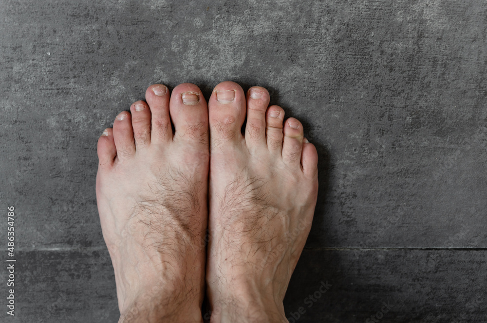 Fototapeta premium male feet with fungus and different dermatological problems close-up on a dark background. hairy feet. toenail problem. foot skin problem