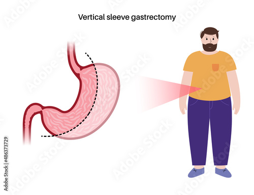 Laparoscopic sleeve gastrectomy