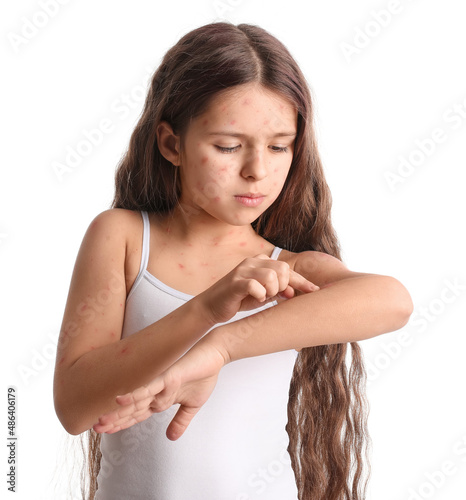 Obraz na plátně Little girl ill with chickenpox isolated on white