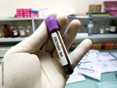 Blood sample for S100 Protein test. Which is screening test for melanoma metastasis photo