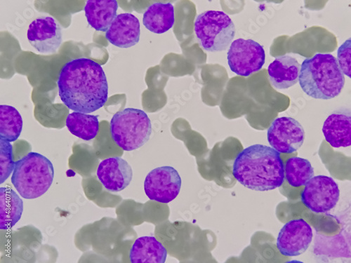 Blood Cancer, Leukemia Awareness. Photomicrograph of bone marrow aspirate showing myeloblasts of acute myeloid leukemia (AML), a cancer of white blood cells