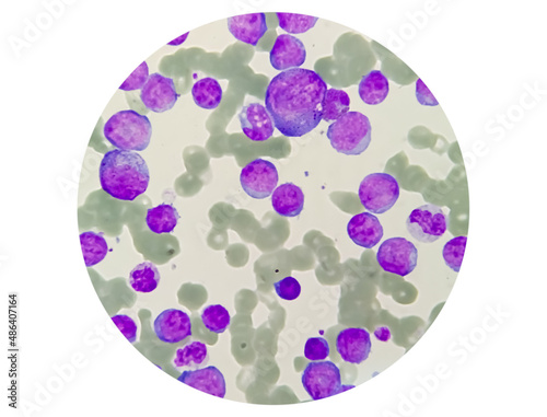 Blood Cancer, Leukemia Awareness. Photomicrograph of bone marrow aspirate showing myeloblasts of acute myeloid leukemia (AML), a cancer of white blood cells