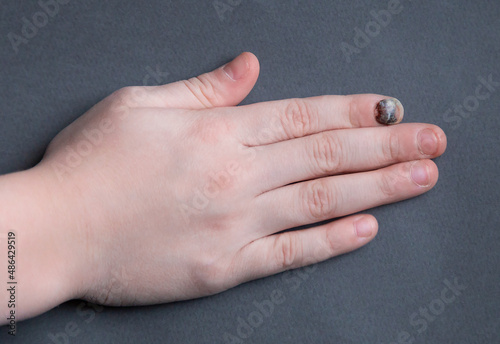 Black sore nail after a strong blow. Finger injury and a hematoma formed under the nail