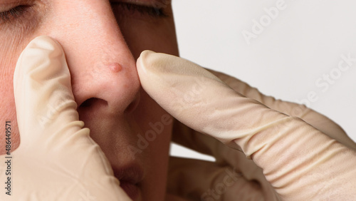 Obraz na płótnie Diagnosis of mole or nevus on woman's face. Doctor's hands in surgical gloves examining nevi on nose. Skin mole check concept. Closeup. Copy space. w salonie