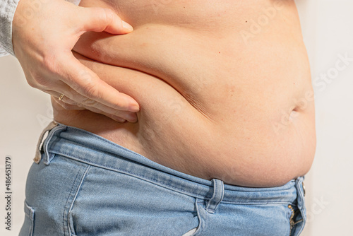 overweight woman holding fold of excess fat on stomach