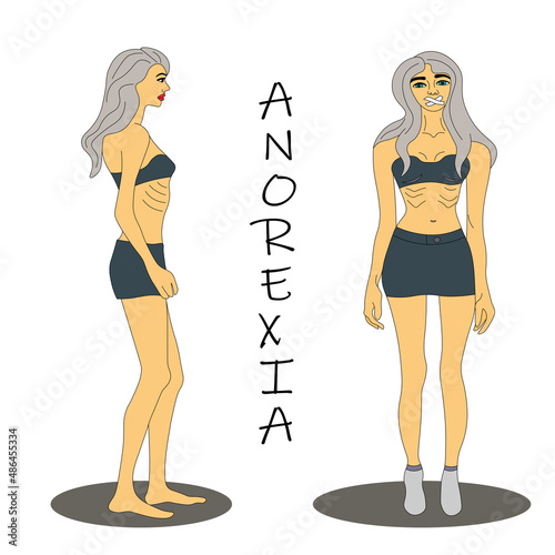 woman suffering from anorexia, severe weight loss. woman's thin body is seen straight and from the side. very thin brunette with the consequences of anorexia syndrome. disease bulimia. Vector. eps 10