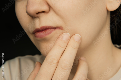 Lip herpes and Angular cheilitis on womans face. Beauty skin female face. Girl facial treatment. Facial skincare. Dermatology, cosmetology. Natural beauty. photo