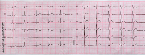 Electrocardiogram close-up on paper, cardiology and health care