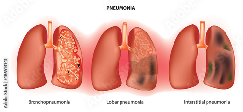 Types of pneumonia (pneumonia in lung)