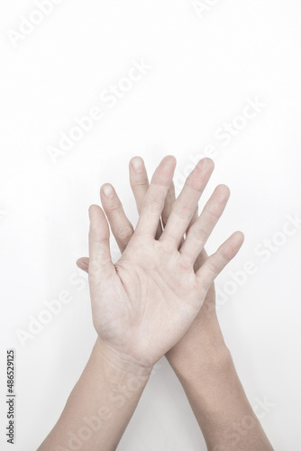 Pale palmar surface of both hands. Anaemic hands of Asian, Chinese man.