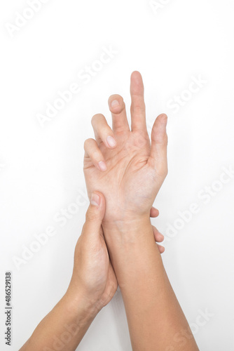Ulnar claw hand of Asian young man. also known as spinster claw. photo