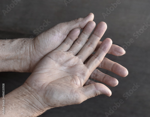 Pale palmar surface of both hands. Anaemic hands of Asian, Chinese man.