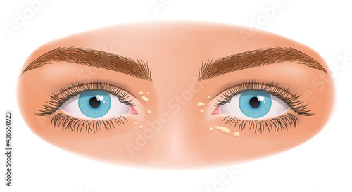 Xanthelasma. Flattened benign neoplasm. Close up of woman eyes with Xanthelasma on the eyelids. Sign of high cholesterol. Dermatology.
