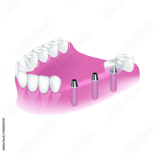 Placement of implants for reconstruction of teeth on the lower jaw. Dental surgery for the placement of metal posts. Vector illustration