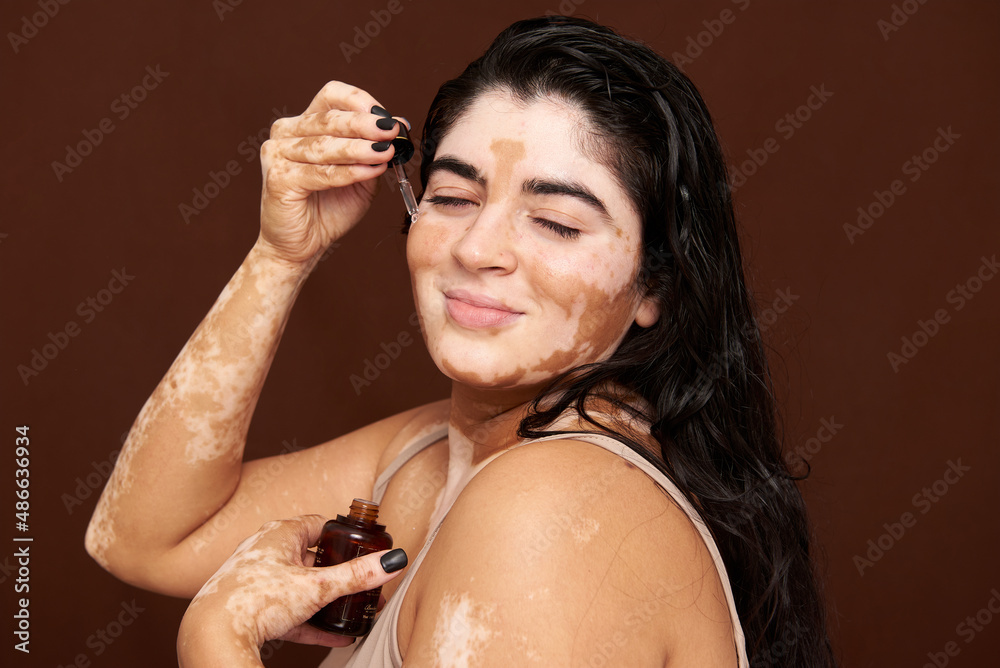 Vitiligo skin girl on her skin routine Stock Photo Adobe Stock