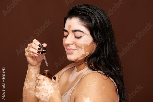 Vitiligo skin girl on her skin routine photo