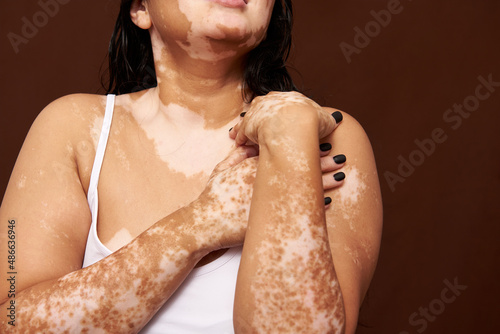 Portrait of an anonymous girl with vitiligo skin 