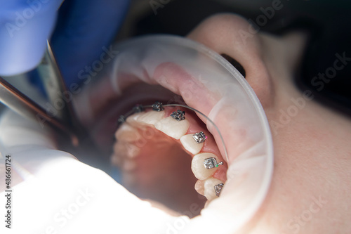 Young girl with metal braces.