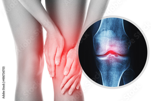 Knee and and X-ray effect with an injured joint