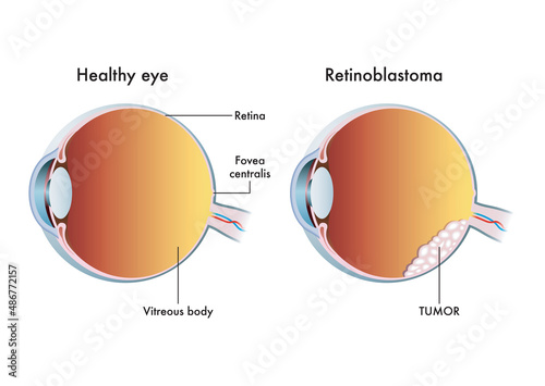 Medical illustration compares a healthy eye with one affected by retinoblastoma. photo