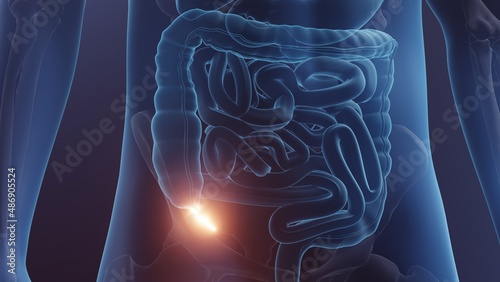 Appendix in human body,  Appendicitis concept photo