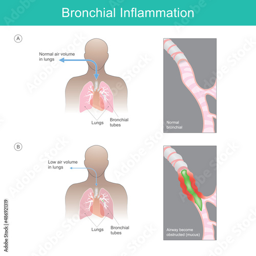 Bronchial Inflammation. Illustration explain Bronchial Inflammation from a virus, bacteria.