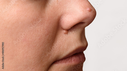 Closeup of two big moles or nevus on face. Nevi on nose of woman. Mole check and skin cancer prevention concept. photo
