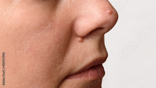 Obraz na płótnie Closeup of two big moles or nevus on face. Nevi on nose of woman. Mole check and skin cancer prevention concept. w salonie