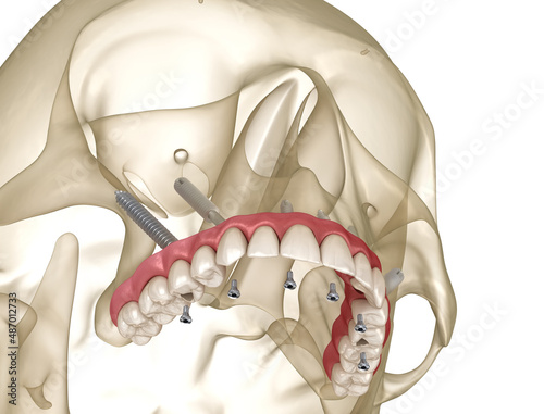 Maxillary prosthesis supported by zygomatic implants. Medically accurate 3D illustration of human teeth and dentures photo