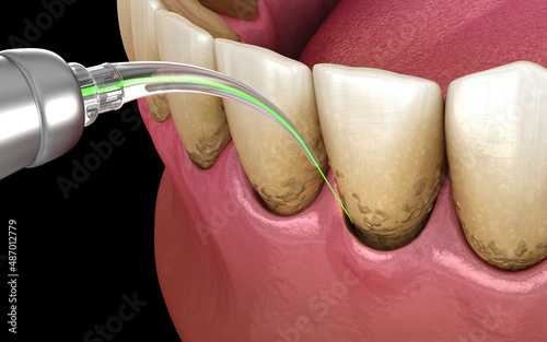 Laser removes tartar and thin layer of infected skin, teeth cleaning. Medically accurate tooth 3D illustration photo