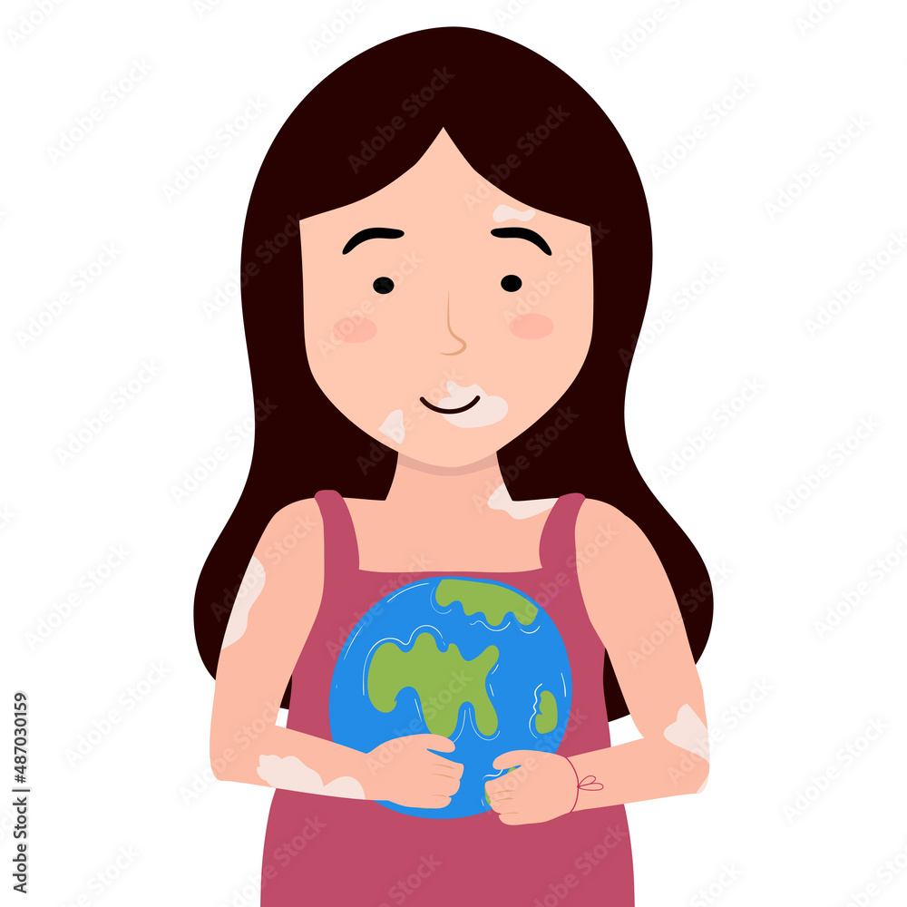 Young Girl in Depigmentation Disease. Girl Holds Globe. World Vitiligo Day vector illustration in cartoon style Young Girl in Depigmentation Disease. Girl Holds Globe. World Vitiligo Day vector illustration in cartoon style