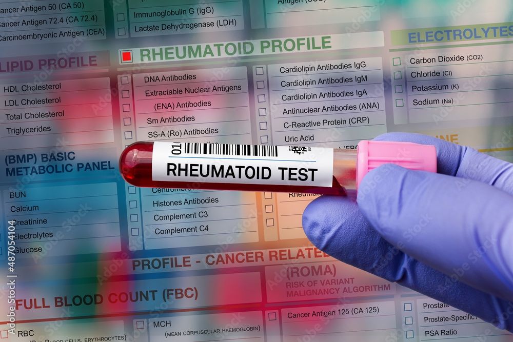 Usmle Rheum Lab Blood tube test with requisition form for Rheumatoid test. Blood sample ...
