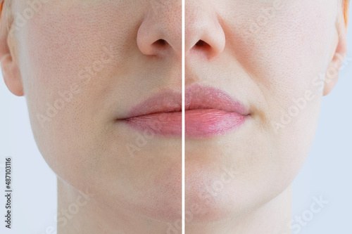 Augmentation of the lips of caucasian woman close-up. Cosmetic injections. Before and after.
