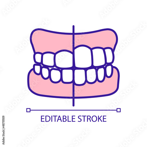 Reshaping teeth surface RGB color icon. Porcelain veneers installation. Covering front of natural teeth. Isolated vector illustration. Simple filled line drawing. Editable stroke. Arial font used