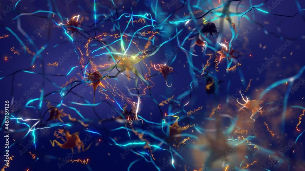 Amyloid plaques forming between neurons. Beta-amyloid protein disrupting nerve cells function in a brain with Alzheimer's disease