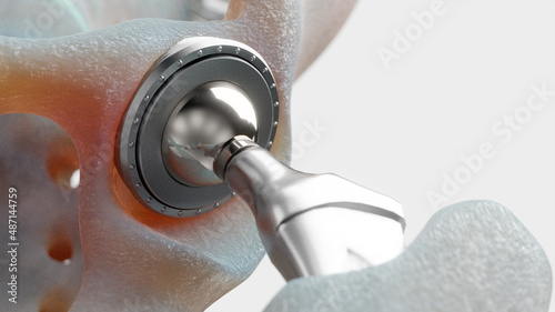 3D Rendering of Hip Implant Detail photo
